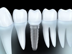 Tooth human implant (done in 3d graphics)